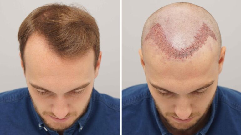 FUE Hair Transplant