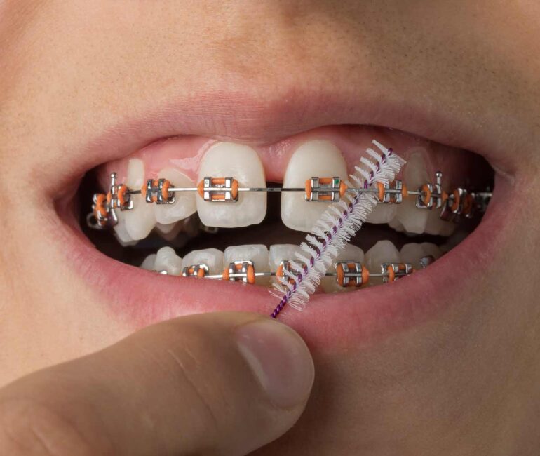 How to Clean Clear Braces Brackets